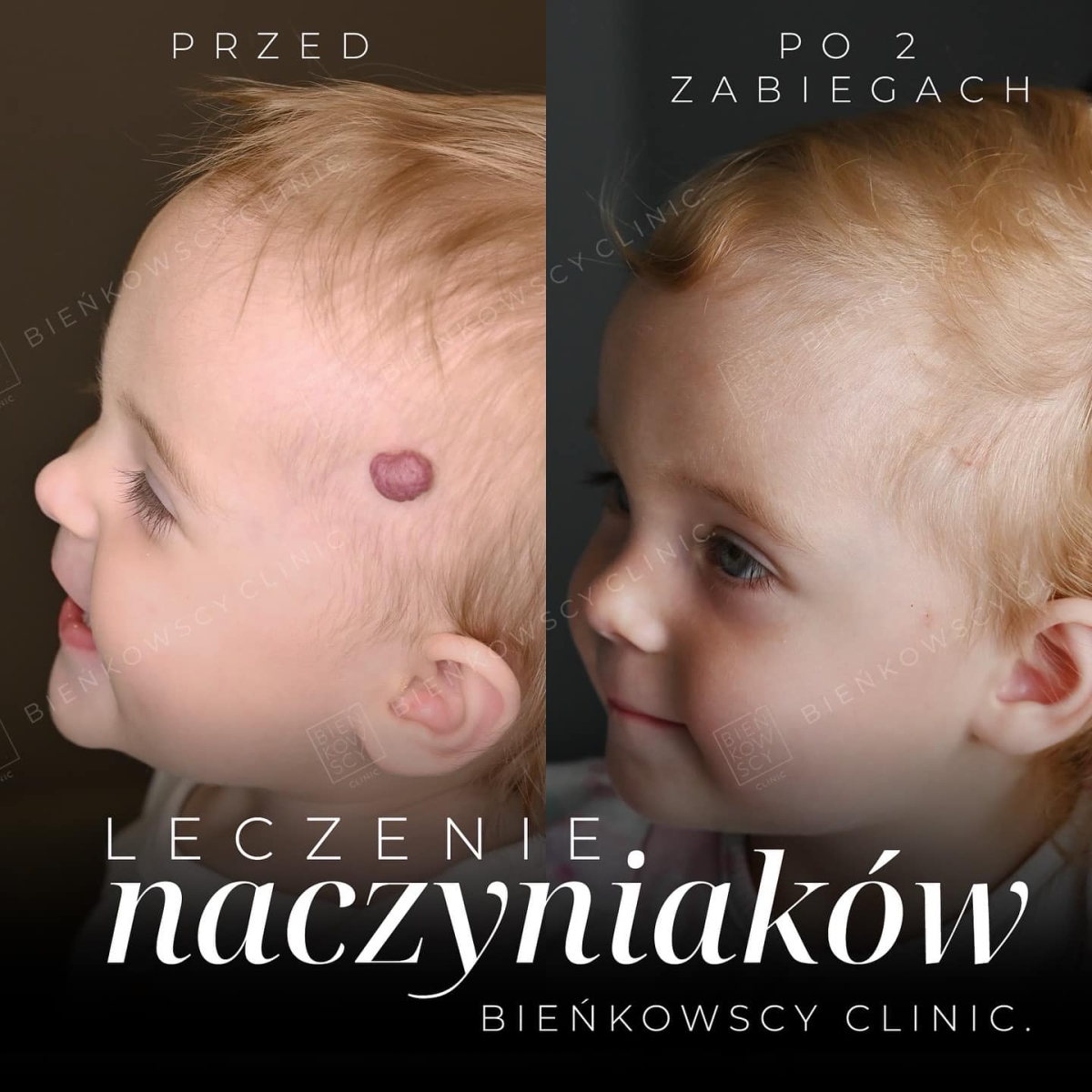 leczenie-naczyniakow-u-dzieci-bienkowscy-clinic-laser